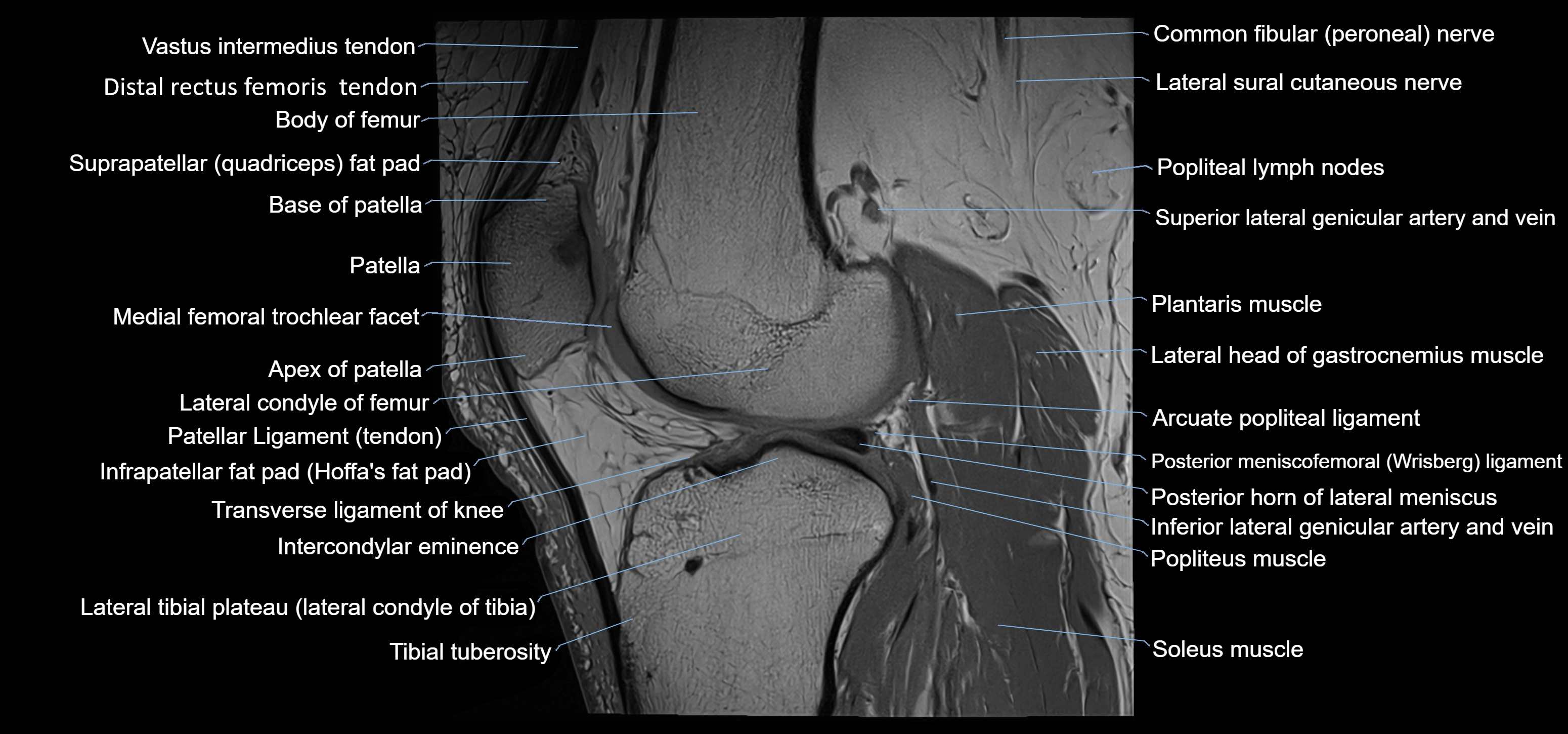 MRI knee sagittal cross sectional anatomy labelled 3T radiology image-00029.webp